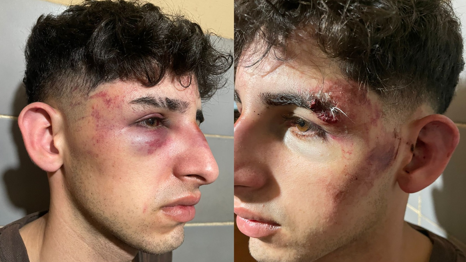 Denunció a guardias de un boliche posadeño por golpiza: "Me estaban por matar"